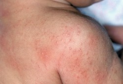 Does Your Child Have Psoriasis? | The Natural Psoriasis Treatment Program